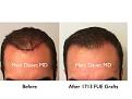 Click image for larger version

Name:	Hair Transplant Slides copy1111.001.jpg
Views:	292
Size:	12.7 KB
ID:	479843