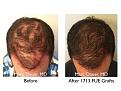 Click image for larger version

Name:	Hair Transplant Slides copy1111.002.jpg
Views:	286
Size:	16.7 KB
ID:	479844