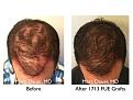 Click image for larger version

Name:	Hair Transplant Slides copy1111.002.jpg
Views:	367
Size:	16.7 KB
ID:	479844