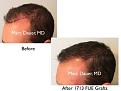 Click image for larger version

Name:	Hair Transplant Slides copy1111.003.jpg
Views:	270
Size:	12.1 KB
ID:	479845