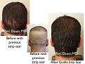 Click image for larger version

Name:	Hair Transplant Slides copy1111.005.jpg
Views:	278
Size:	17.3 KB
ID:	479847