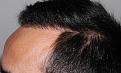 Click image for larger version

Name:	as 1 year post op 2nd sx L profile.jpg
Views:	470
Size:	98.8 KB
ID:	480086