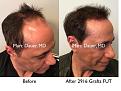 Click image for larger version

Name:	Hair Transplant Slides copy01.005.jpg
Views:	343
Size:	16.9 KB
ID:	481686