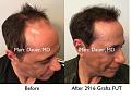 Click image for larger version

Name:	Hair Transplant Slides copy01.005.jpg
Views:	417
Size:	16.9 KB
ID:	481686