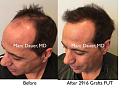 Click image for larger version

Name:	Hair Transplant Slides copy01.006.jpg
Views:	431
Size:	16.8 KB
ID:	481687