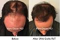 Click image for larger version

Name:	Hair Transplant Slides copy01.007.jpg
Views:	336
Size:	16.3 KB
ID:	481688