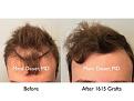 Click image for larger version

Name:	Hair Transplant Slides copy07.001.jpg
Views:	352
Size:	14.3 KB
ID:	481807