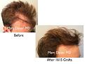 Click image for larger version

Name:	Hair Transplant Slides copy07.002.jpg
Views:	320
Size:	13.4 KB
ID:	481808