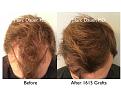 Click image for larger version

Name:	Hair Transplant Slides copy07.004.jpg
Views:	338
Size:	17.6 KB
ID:	481810