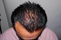 Click image for larger version

Name:	jm 1 year post chin down.jpg
Views:	262
Size:	96.0 KB
ID:	481888