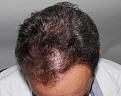 Click image for larger version

Name:	ar z2 years post-op chin down.jpg
Views:	371
Size:	95.6 KB
ID:	482087