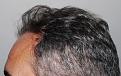 Click image for larger version

Name:	ar z2 years post-op L profile.jpg
Views:	337
Size:	98.2 KB
ID:	482090
