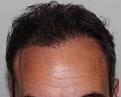 Click image for larger version

Name:	ar z2 years post-op front.jpg
Views:	400
Size:	93.3 KB
ID:	482093