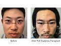 Click image for larger version

Name:	FUE eyebrows.001.jpg
Views:	232
Size:	15.3 KB
ID:	483026