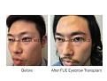 Click image for larger version

Name:	FUE eyebrows.002.jpg
Views:	318
Size:	13.7 KB
ID:	483027