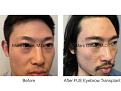 Click image for larger version

Name:	FUE eyebrows.003.jpg
Views:	310
Size:	14.7 KB
ID:	483028
