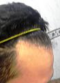 Click image for larger version

Name:	5. HAIRLINE RIGHT TEMPLE.jpg
Views:	125
Size:	60.1 KB
ID:	483134