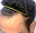 Click image for larger version

Name:	6. HAIRLINE LEFT TEMPLE.jpg
Views:	197
Size:	63.8 KB
ID:	483143