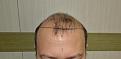 Click image for larger version

Name:	Best-FUE-hair-transplant-India (1).jpg
Views:	297
Size:	90.7 KB
ID:	483341