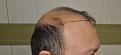 Click image for larger version

Name:	Best-FUE-hair-transplant-India (3).jpg
Views:	304
Size:	93.1 KB
ID:	483342