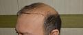 Click image for larger version

Name:	Best-FUE-hair-transplant-India (2).jpg
Views:	454
Size:	94.3 KB
ID:	483343