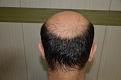 Click image for larger version

Name:	Best-FUE-hair-transplant-India (4).jpg
Views:	369
Size:	90.7 KB
ID:	483344
