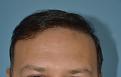Click image for larger version

Name:	Best-FUE-hair-transplant-India (5).jpg
Views:	427
Size:	90.2 KB
ID:	483345