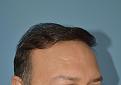 Click image for larger version

Name:	Best-FUE-hair-transplant-India (7).jpg
Views:	463
Size:	87.6 KB
ID:	483346