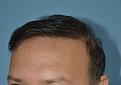 Click image for larger version

Name:	Best-FUE-hair-transplant-India (6).jpg
Views:	549
Size:	89.8 KB
ID:	483347