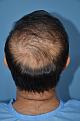 Click image for larger version

Name:	Best-FUE-hair-transplant-India (8).jpg
Views:	1080
Size:	91.3 KB
ID:	483348