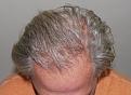 Click image for larger version

Name:	kr 1 year post-op chin down.jpg
Views:	298
Size:	96.1 KB
ID:	483586