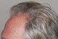 Click image for larger version

Name:	kr 1 year post-op L profile.jpg
Views:	270
Size:	96.5 KB
ID:	483588