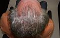 Click image for larger version

Name:	kr 1 year post-op chin up.jpg
Views:	276
Size:	95.3 KB
ID:	483590