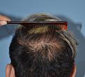 Click image for larger version

Name:	Darling Buds Clinic India_crown_after.jpg
Views:	292
Size:	94.4 KB
ID:	483937