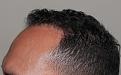 Click image for larger version

Name:	jz 1 year post-op R profile.jpg
Views:	284
Size:	93.0 KB
ID:	485660