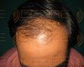 Click image for larger version

Name:	Hair Transplant Images.jpg
Views:	197
Size:	91.0 KB
ID:	485746