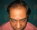 Click image for larger version

Name:	Hair Transplant Days.jpg
Views:	343
Size:	82.7 KB
ID:	485747