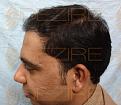 Click image for larger version

Name:	Hair Transplant Side Effect.jpg
Views:	362
Size:	84.4 KB
ID:	485748