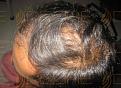 Click image for larger version

Name:	Hair Transplant Near.jpg
Views:	347
Size:	93.4 KB
ID:	485749