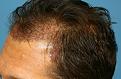 Click image for larger version

Name:	jb imm post op L profile.jpg
Views:	297
Size:	94.5 KB
ID:	485891