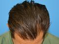 Click image for larger version

Name:	jb 1 year post op chin down.jpg
Views:	311
Size:	34.0 KB
ID:	485893
