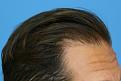 Click image for larger version

Name:	jb 1 year post R profile.jpg
Views:	306
Size:	76.8 KB
ID:	485896