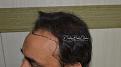 Click image for larger version

Name:	Darling Buds Clinic hair transplant pre op 3.jpg
Views:	262
Size:	92.4 KB
ID:	485900