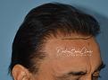 Click image for larger version

Name:	Darling Buds Clinic hair transplant post op 3.jpg
Views:	286
Size:	92.9 KB
ID:	485904