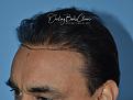 Click image for larger version

Name:	Darling Buds Clinic hair transplant post op 4.jpg
Views:	194
Size:	91.7 KB
ID:	485905