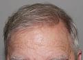 Click image for larger version

Name:	lk 1.5 yr post-op front.jpg
Views:	237
Size:	94.6 KB
ID:	486435