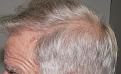 Click image for larger version

Name:	lk 1.5 yr post-op L profile.jpg
Views:	216
Size:	96.2 KB
ID:	486437