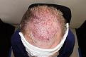 Click image for larger version

Name:	lk immdeiate post-op chin down.jpg
Views:	224
Size:	94.9 KB
ID:	486440