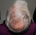 Click image for larger version

Name:	lk 1.5 yr post-op chin up.jpg
Views:	241
Size:	86.5 KB
ID:	486441