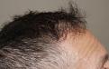 Click image for larger version

Name:	jg 8 yrs post-op R profile.jpg
Views:	234
Size:	95.6 KB
ID:	486762